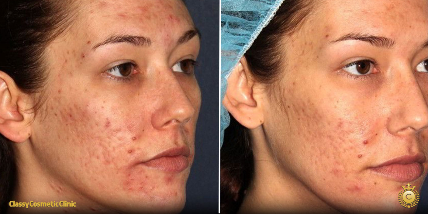 temple filler injection before and after picture