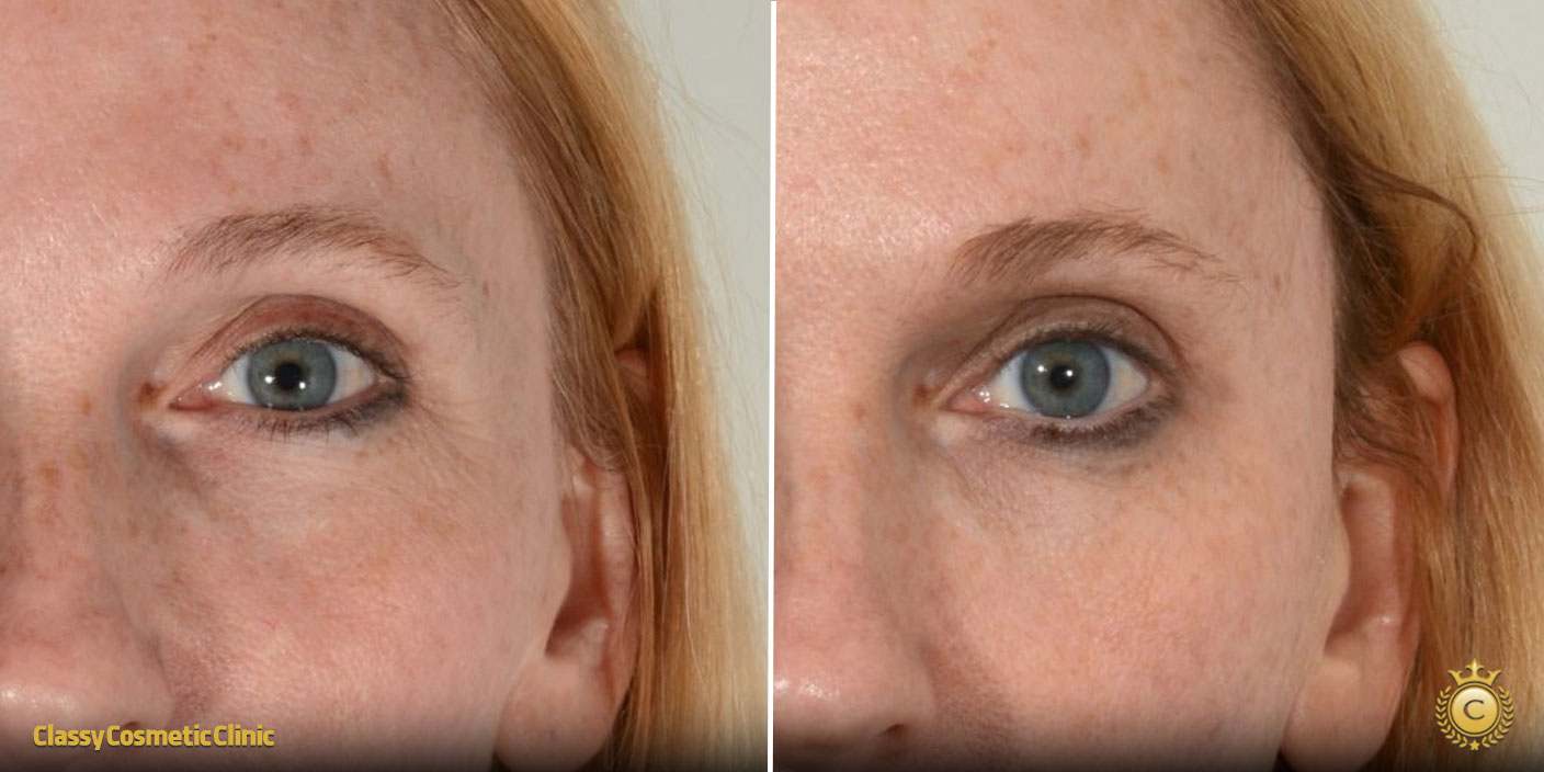 temple filler injection before and after picture