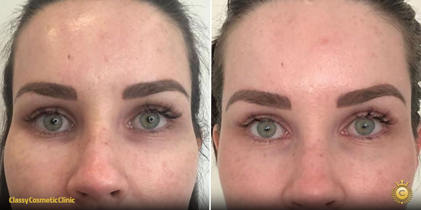 temple filler injection before and after picture