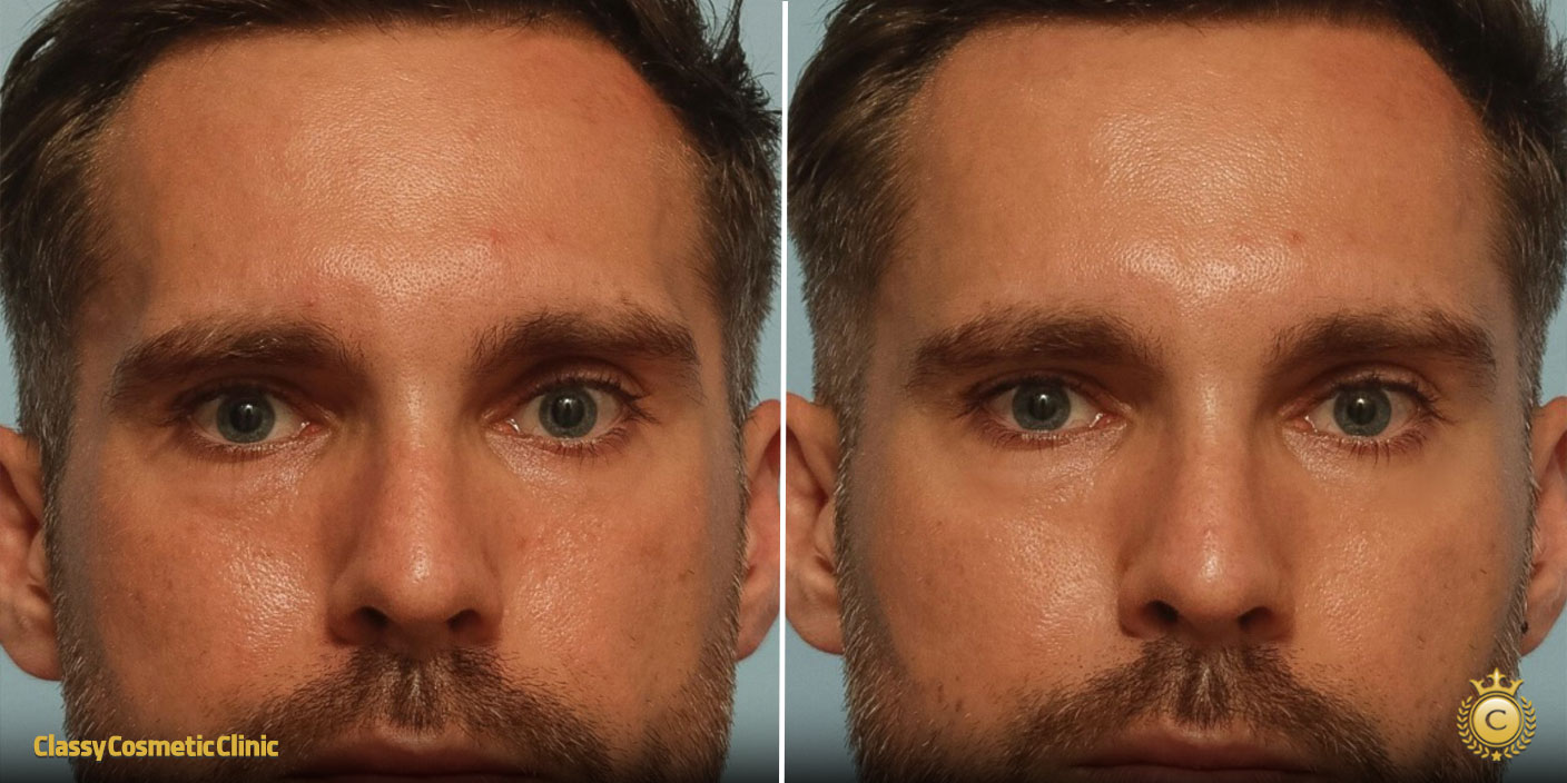 temple filler injection before and after picture