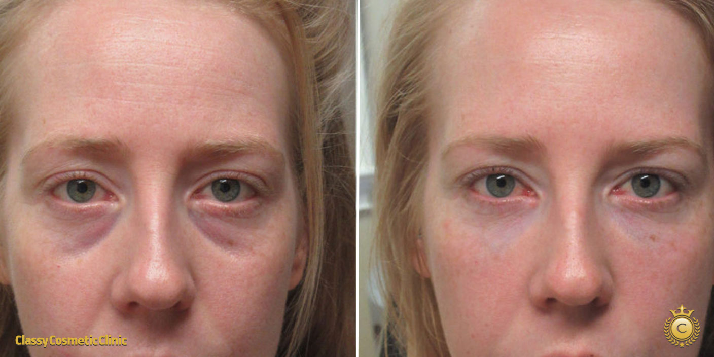 Under Eyes Filler before and after