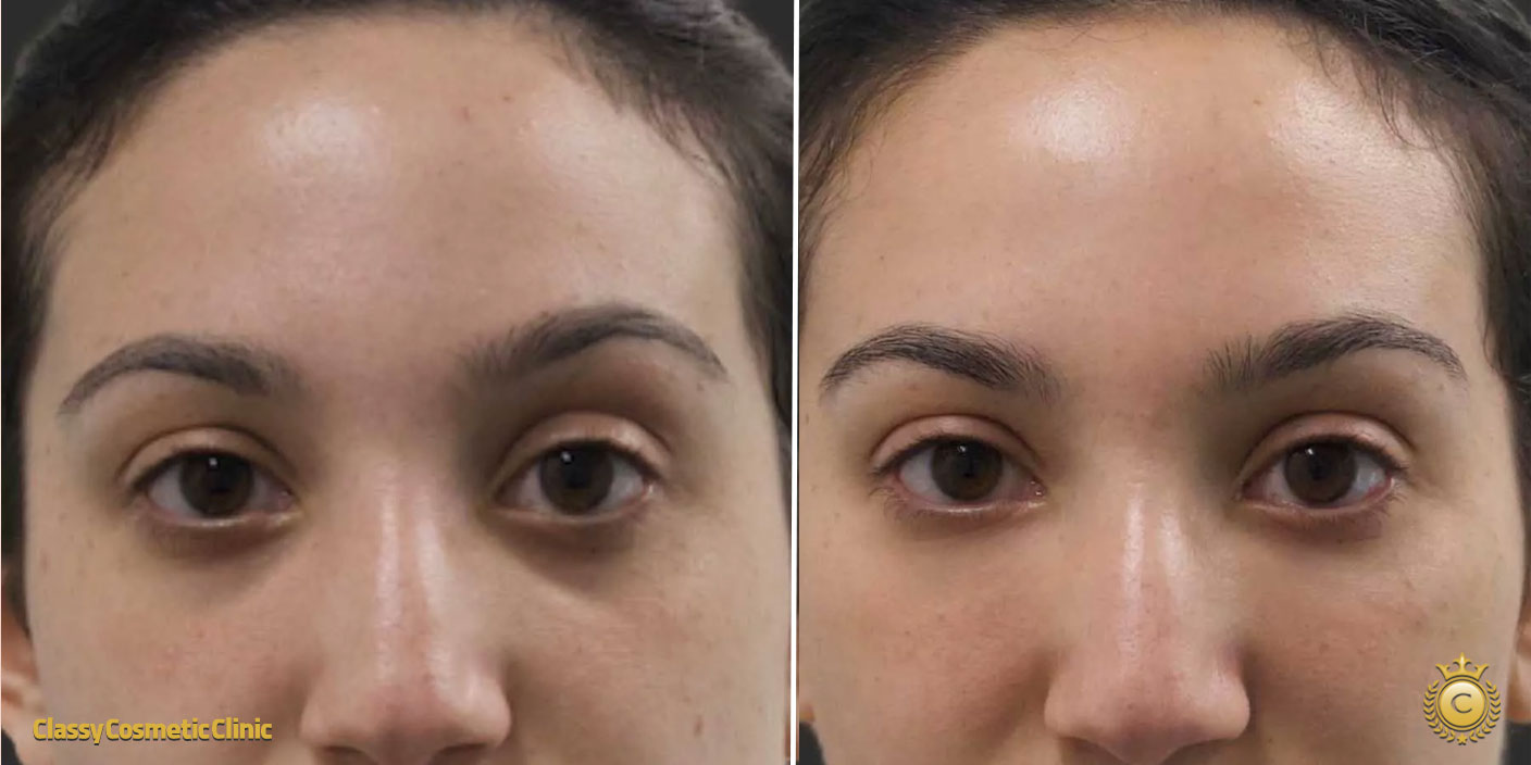 Under Eyes Filler before and after