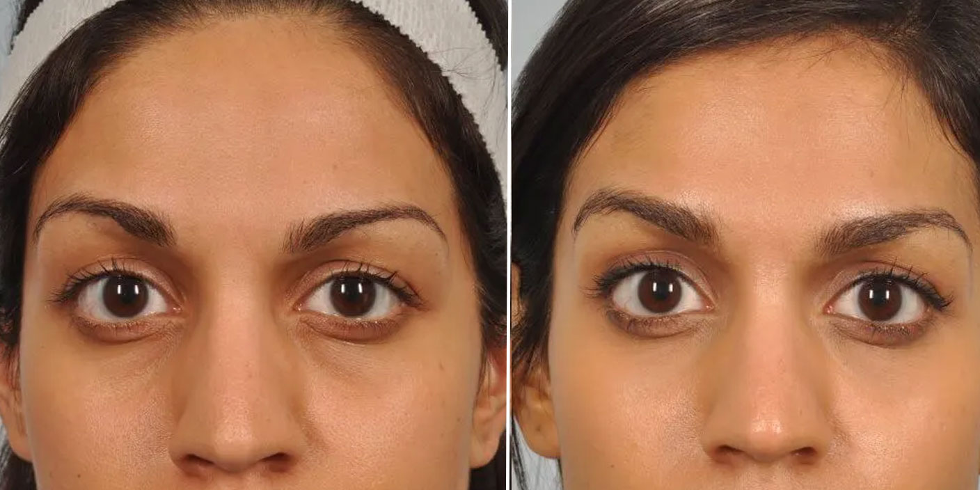 Under Eyes Filler before and after