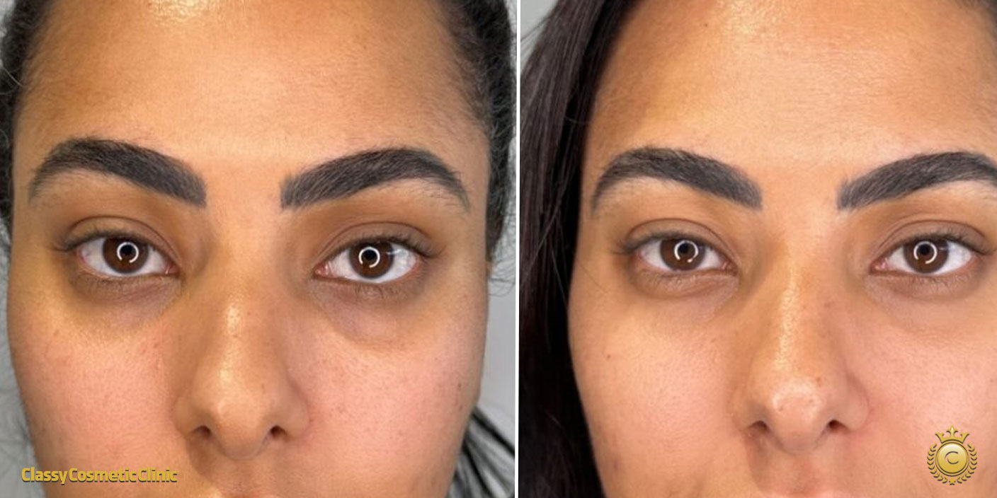 Under Eyes Filler before and after