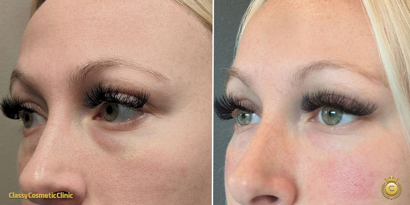 Under Eyes Filler before and after