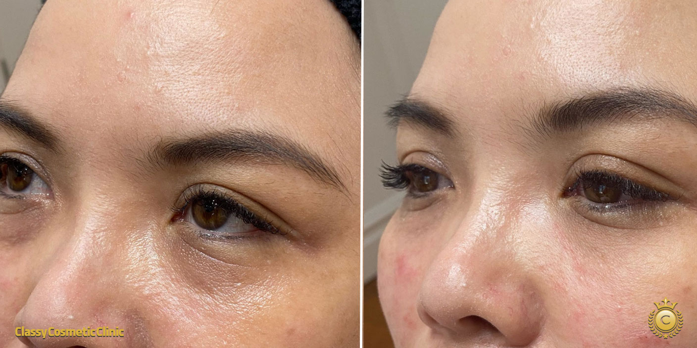 Under Eyes Filler before and after