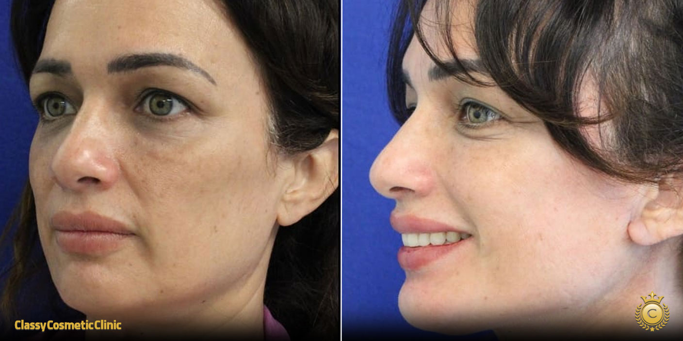 Facelifts for 40 Year Olds before and after