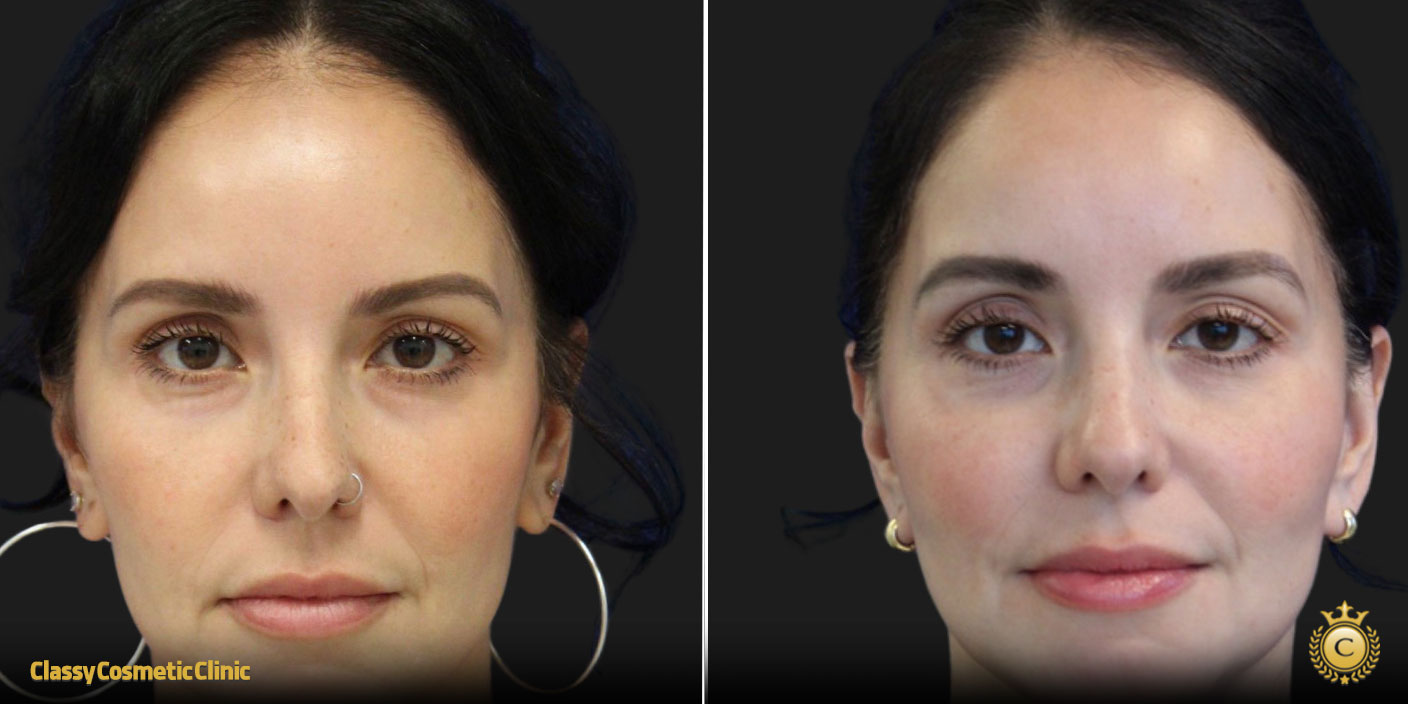 Facelifts for 40 Year Olds before and after