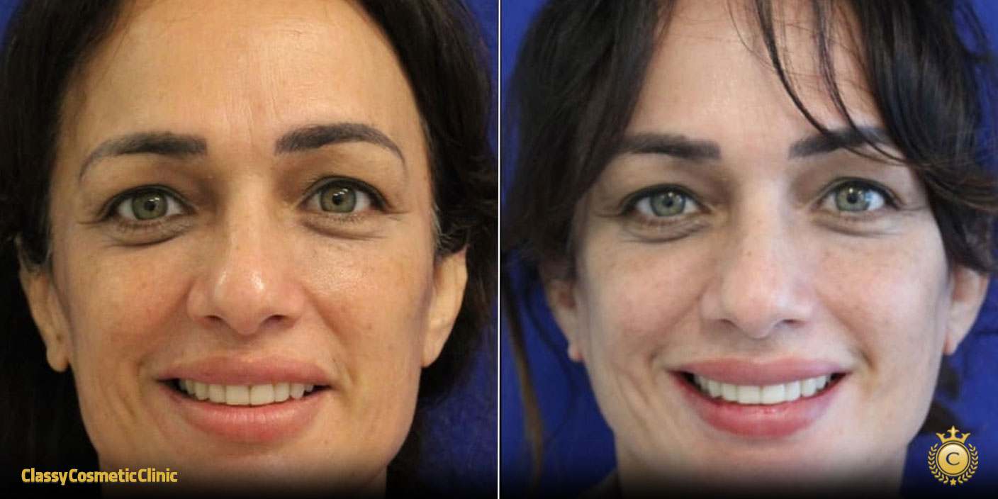 Facelifts for 40 Year Olds before and after