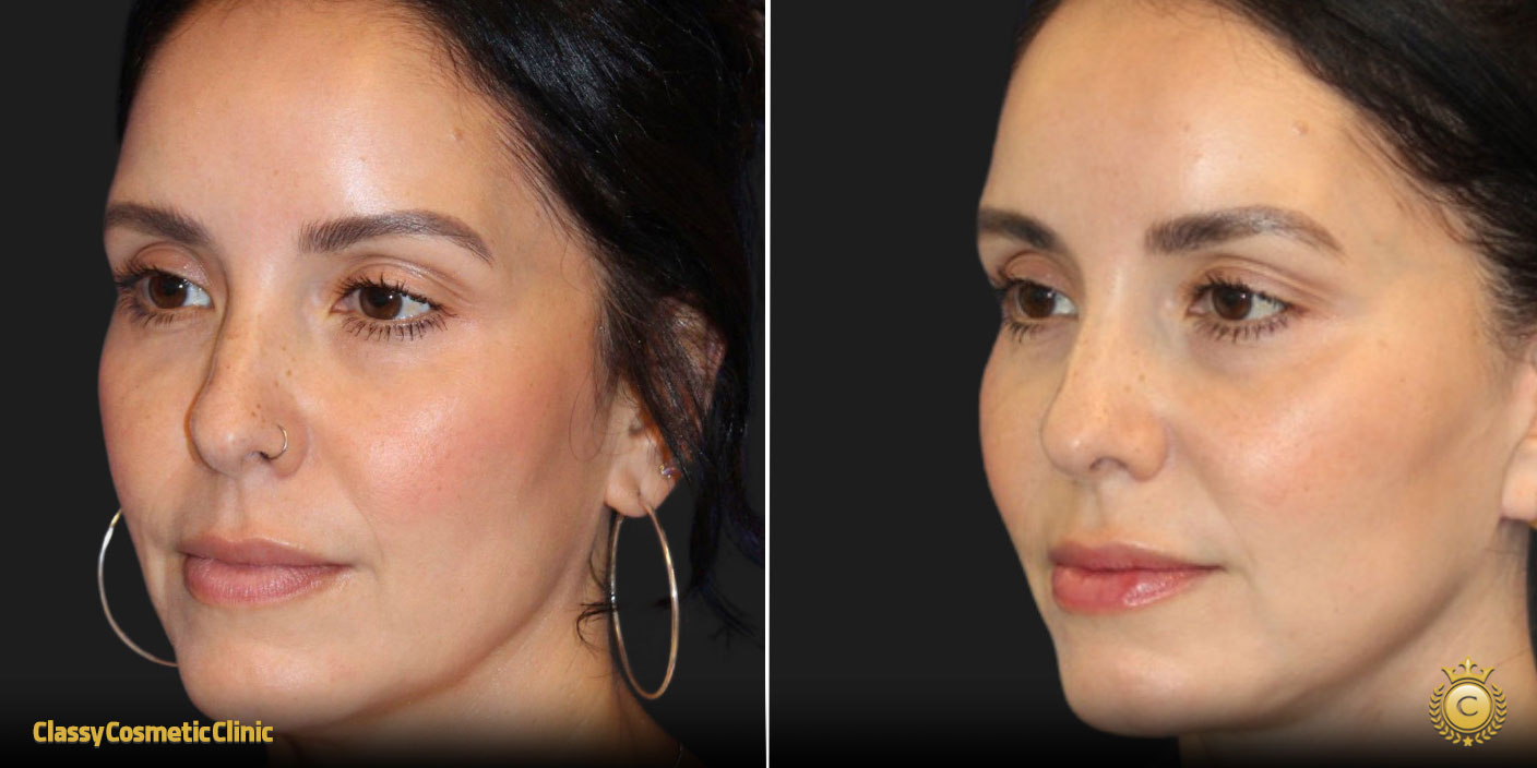 Facelifts for 40 Year Olds before and after