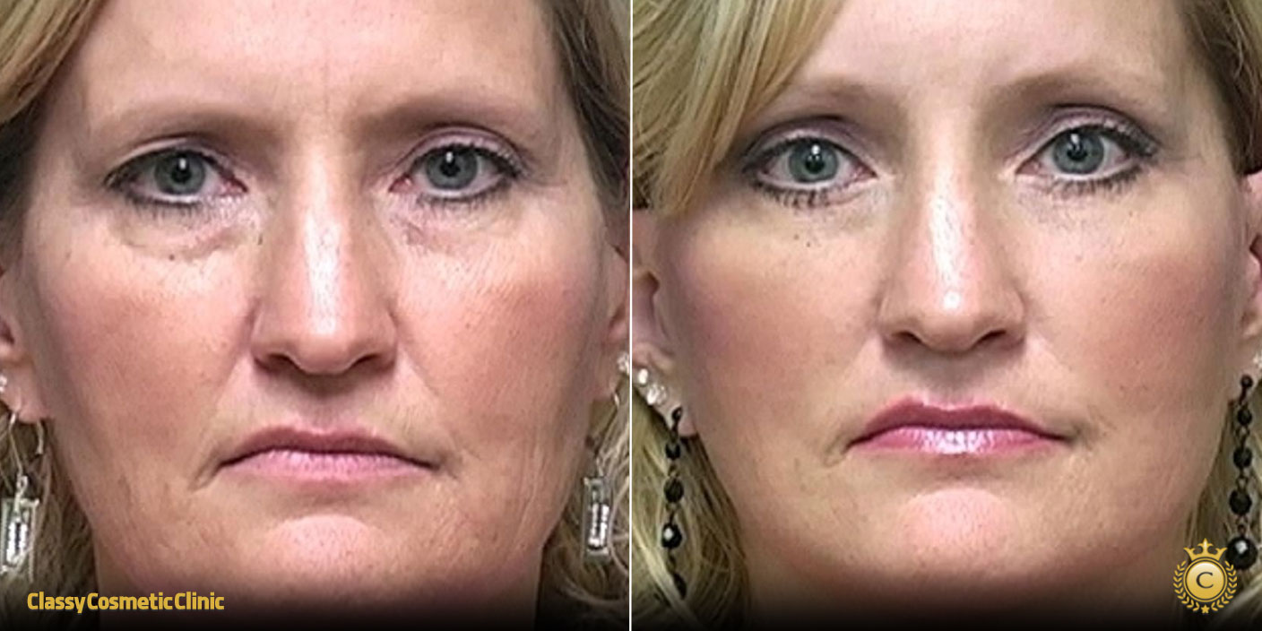 Facelifts for 40 Year Olds before and after