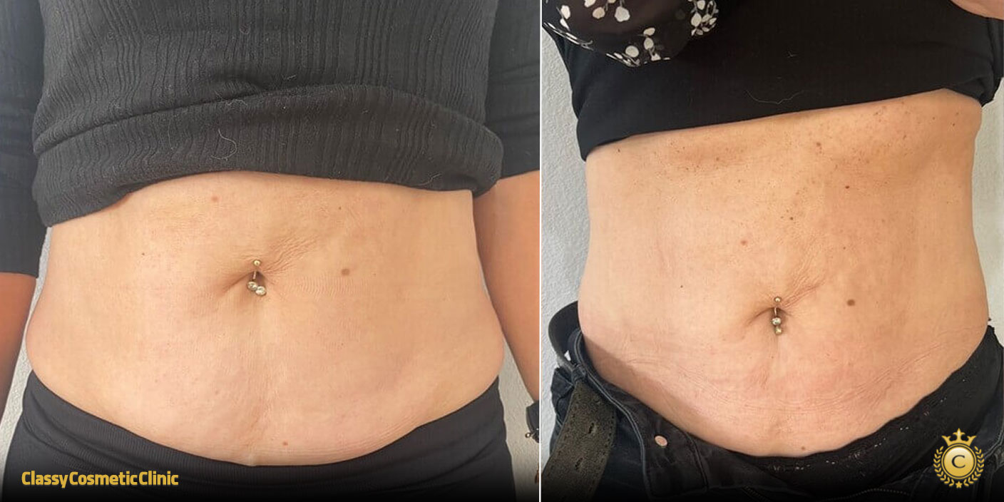 fat burning injection before and after