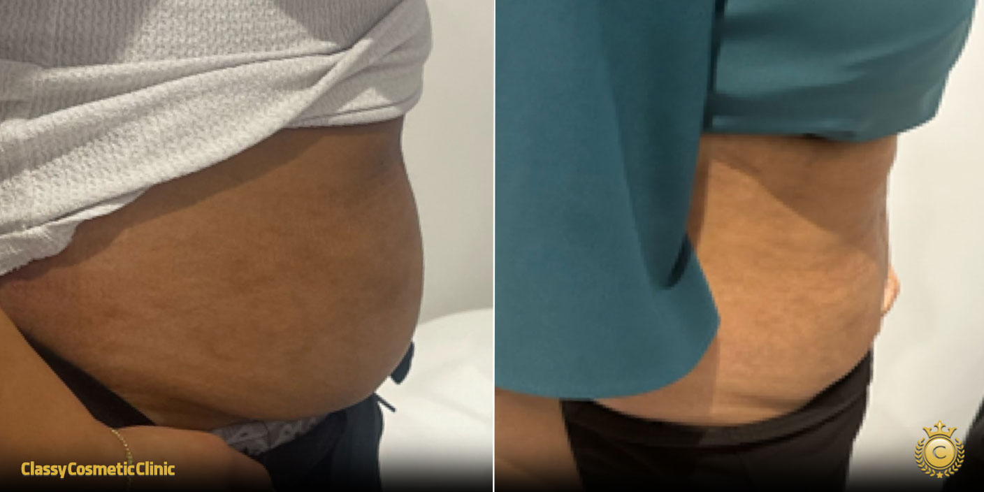 fat burning injection before and after