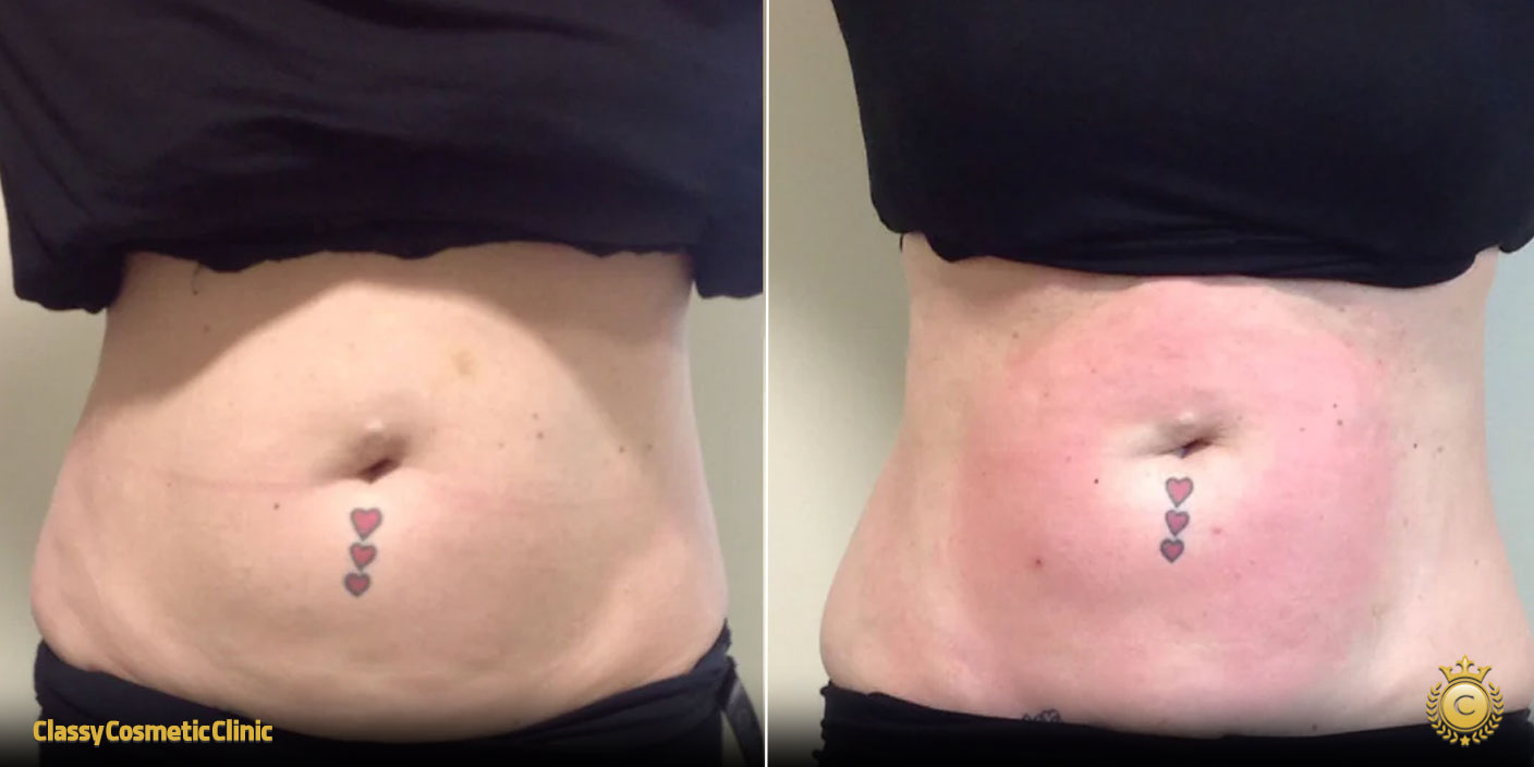 fat burning injection before and after