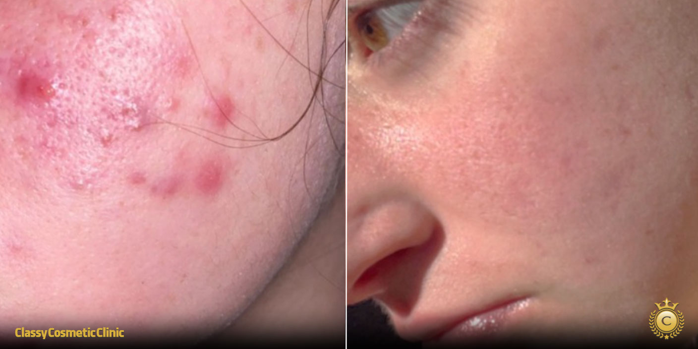 Hyaluronic Acid and Accutane before and after