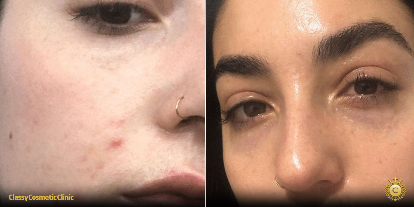 Hyaluronic Acid and Accutane before and after