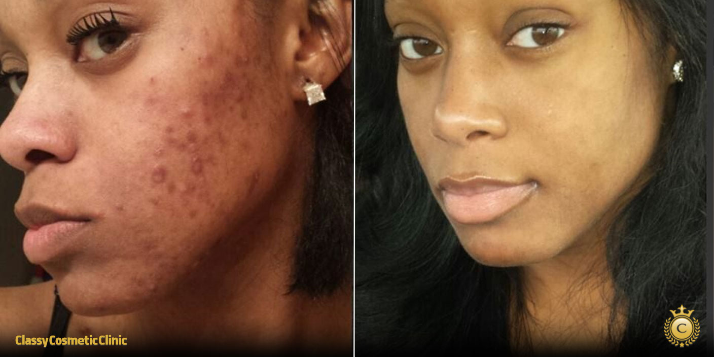 Hyaluronic Acid and Accutane before and after