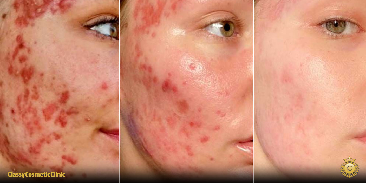 Hyaluronic Acid and Accutane before and after