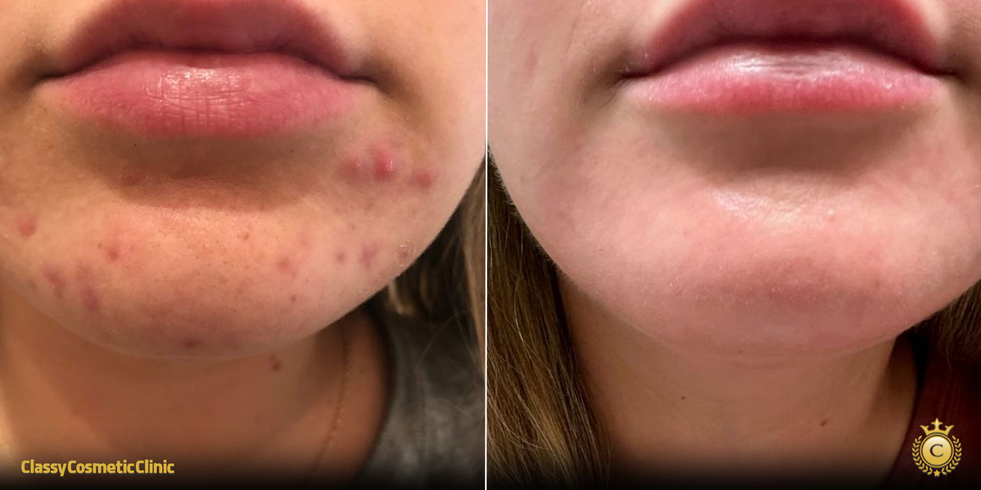 Hyaluronic Acid and Accutane before and after