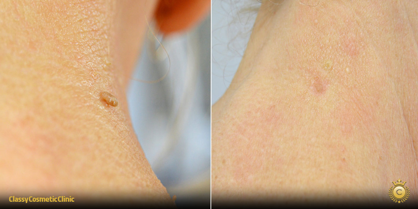 Skin Tag Removal before and after
