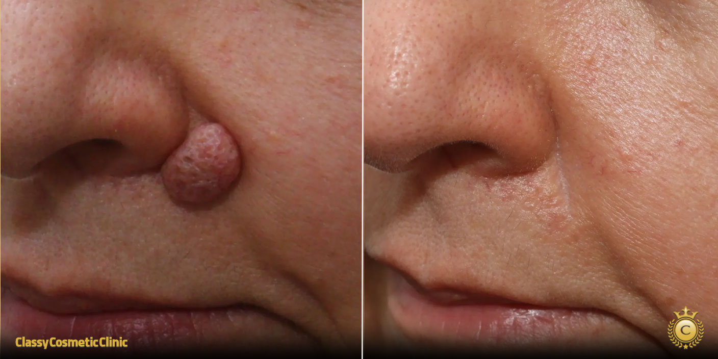 Skin Tag Removal before and after
