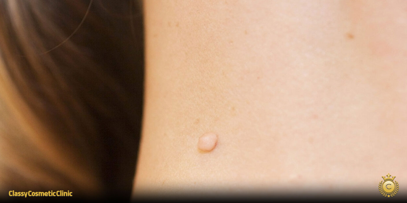 Essential Oils for Skin Tag Removal: Natural Solutions for Clearer Skin