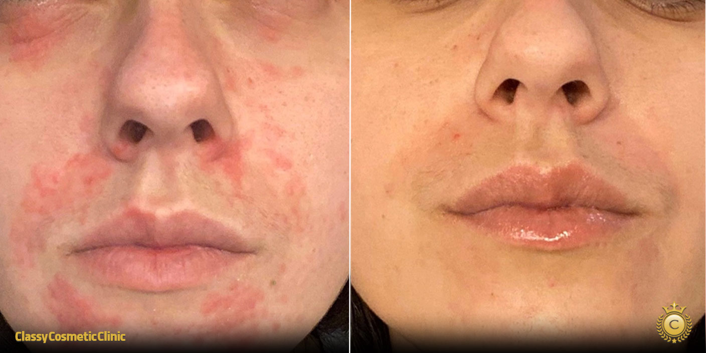 Ultherapy Perioral before and after
