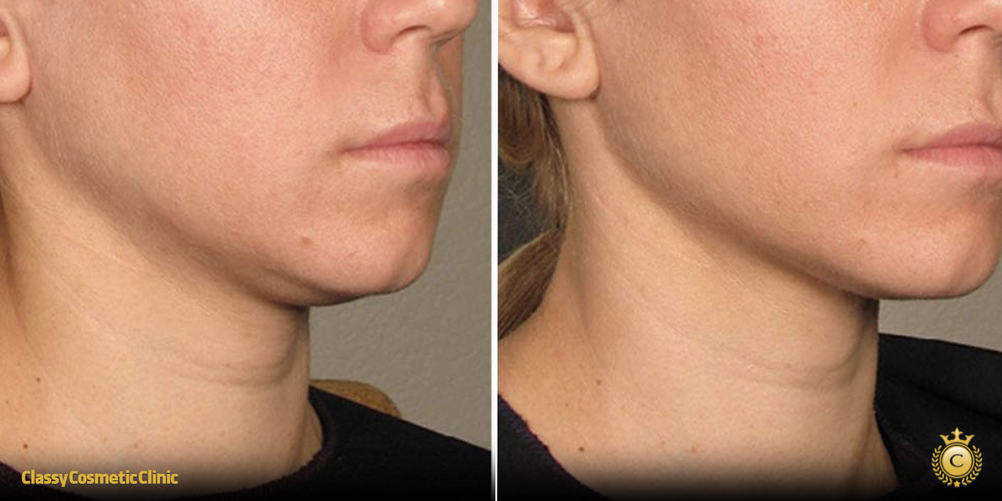 Ultherapy Perioral before and after
