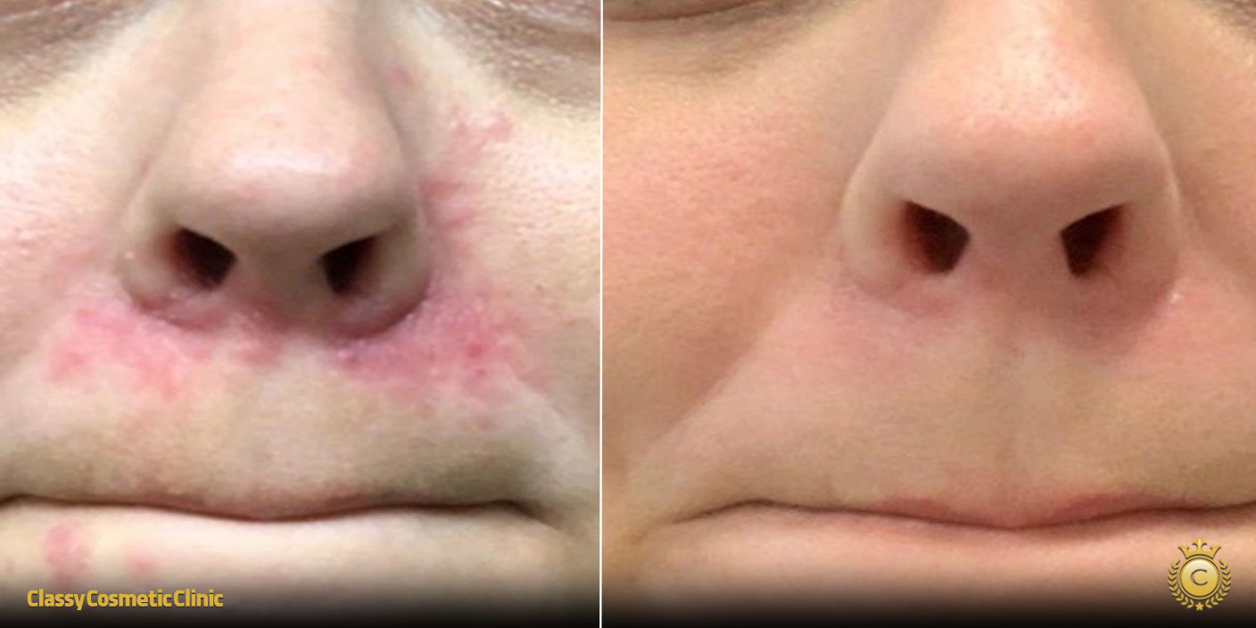 Ultherapy Perioral before and after