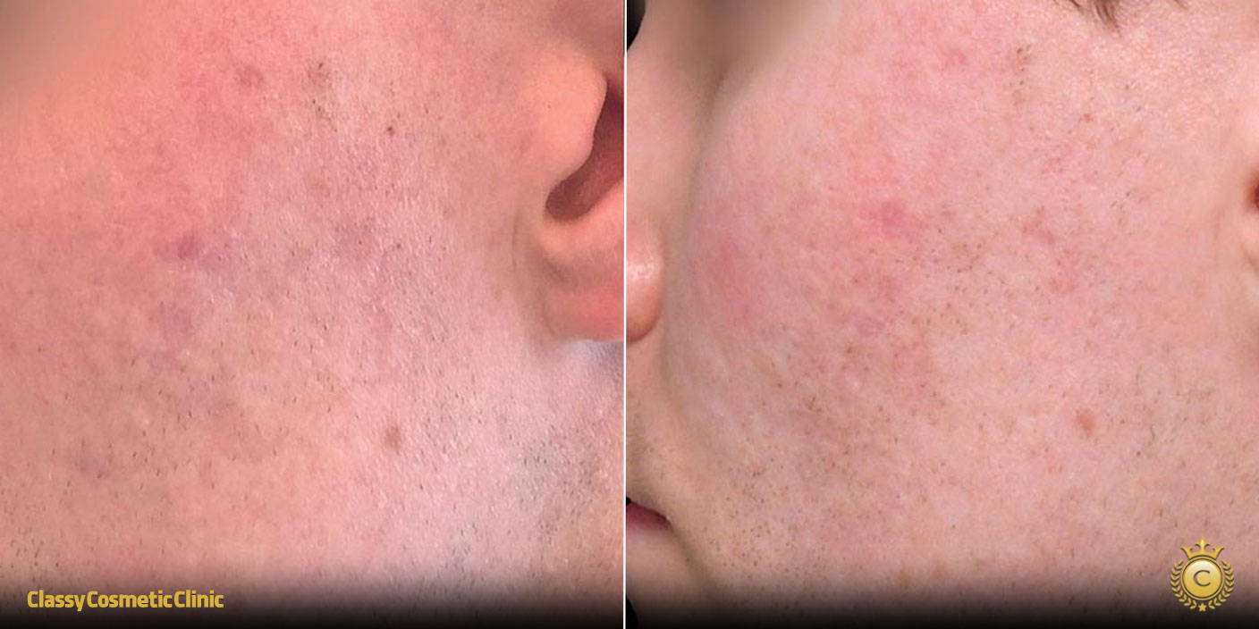 Acne Scars Remedies before and after