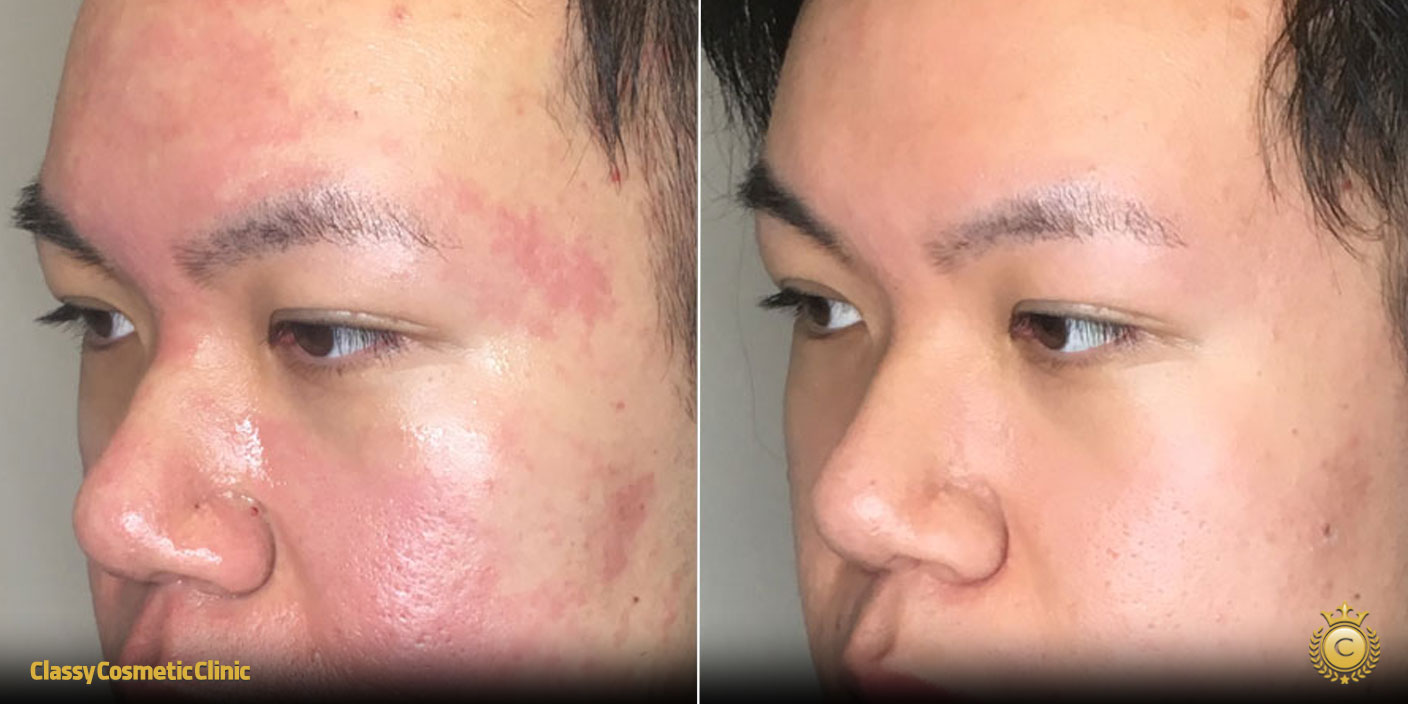 Acne Scars Remedies before and after