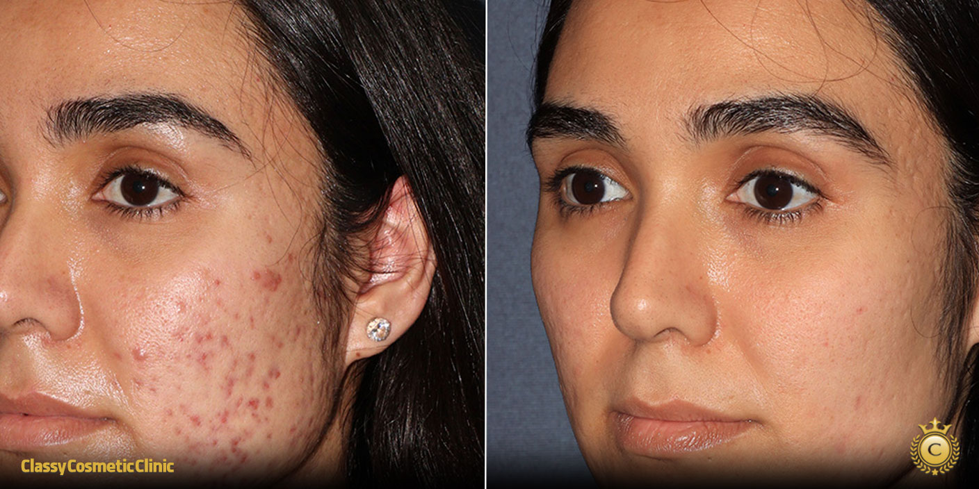 Acne Scars Remedies before and after