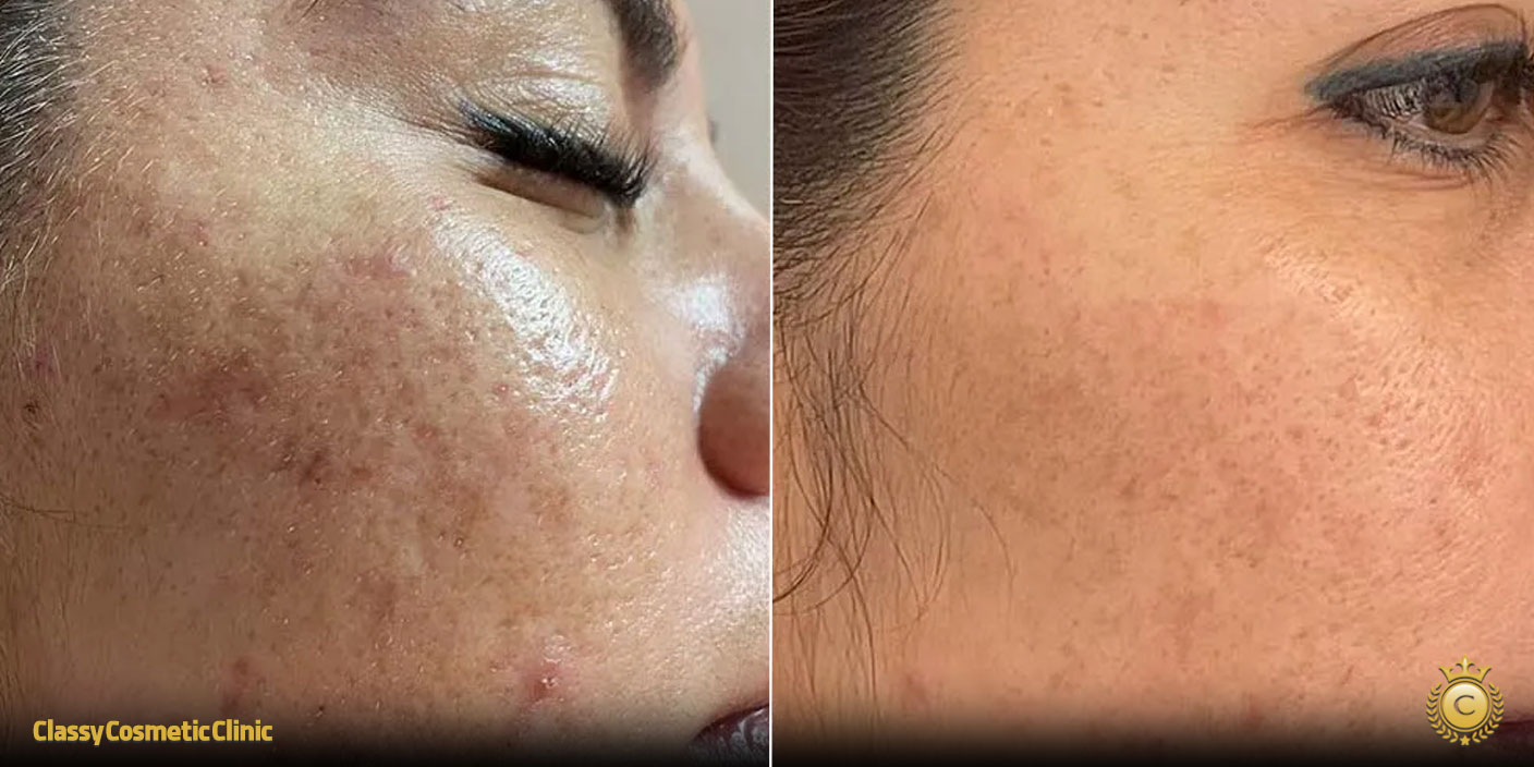 chemical peel before and after