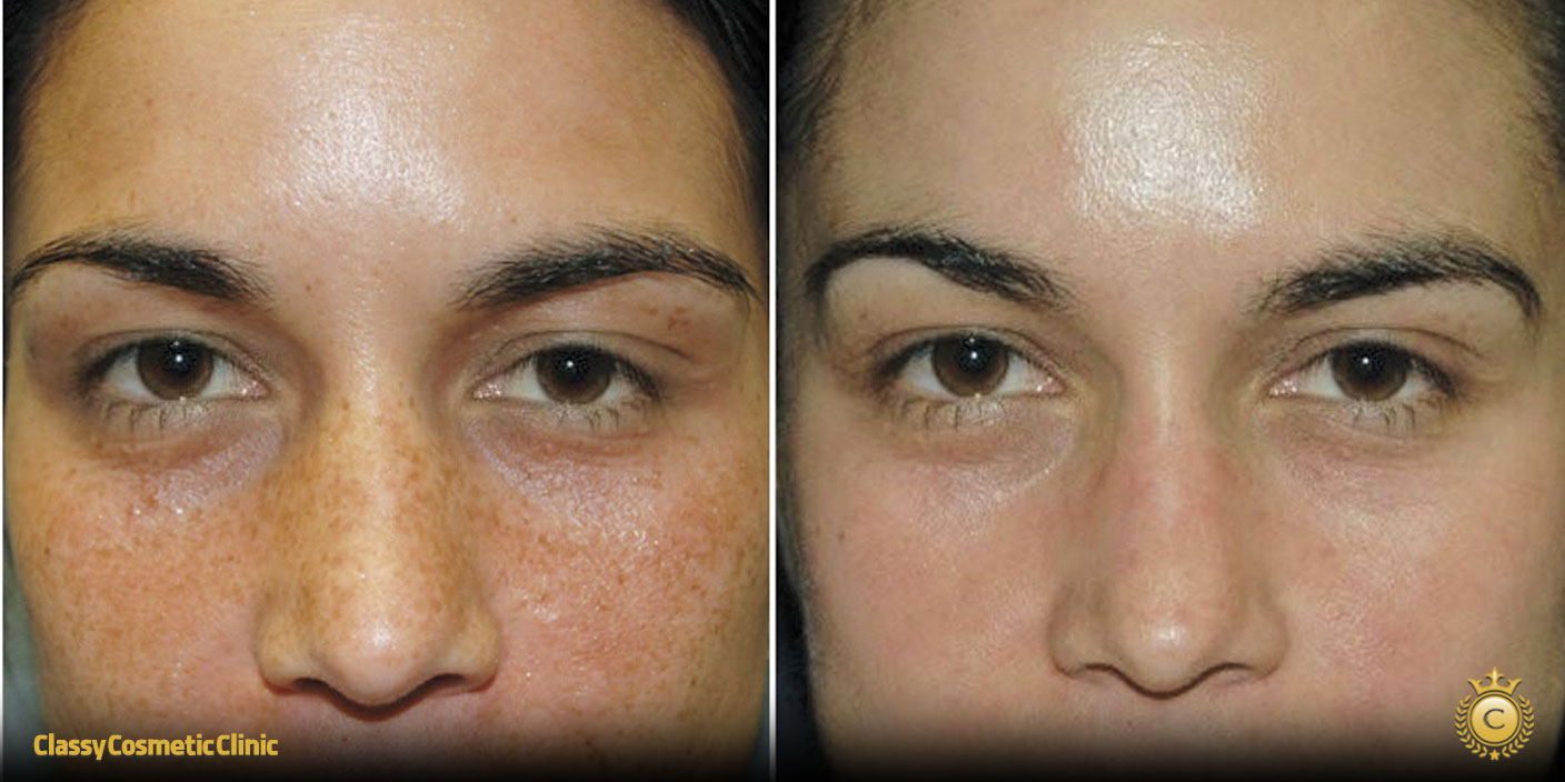 chemical peel before and after