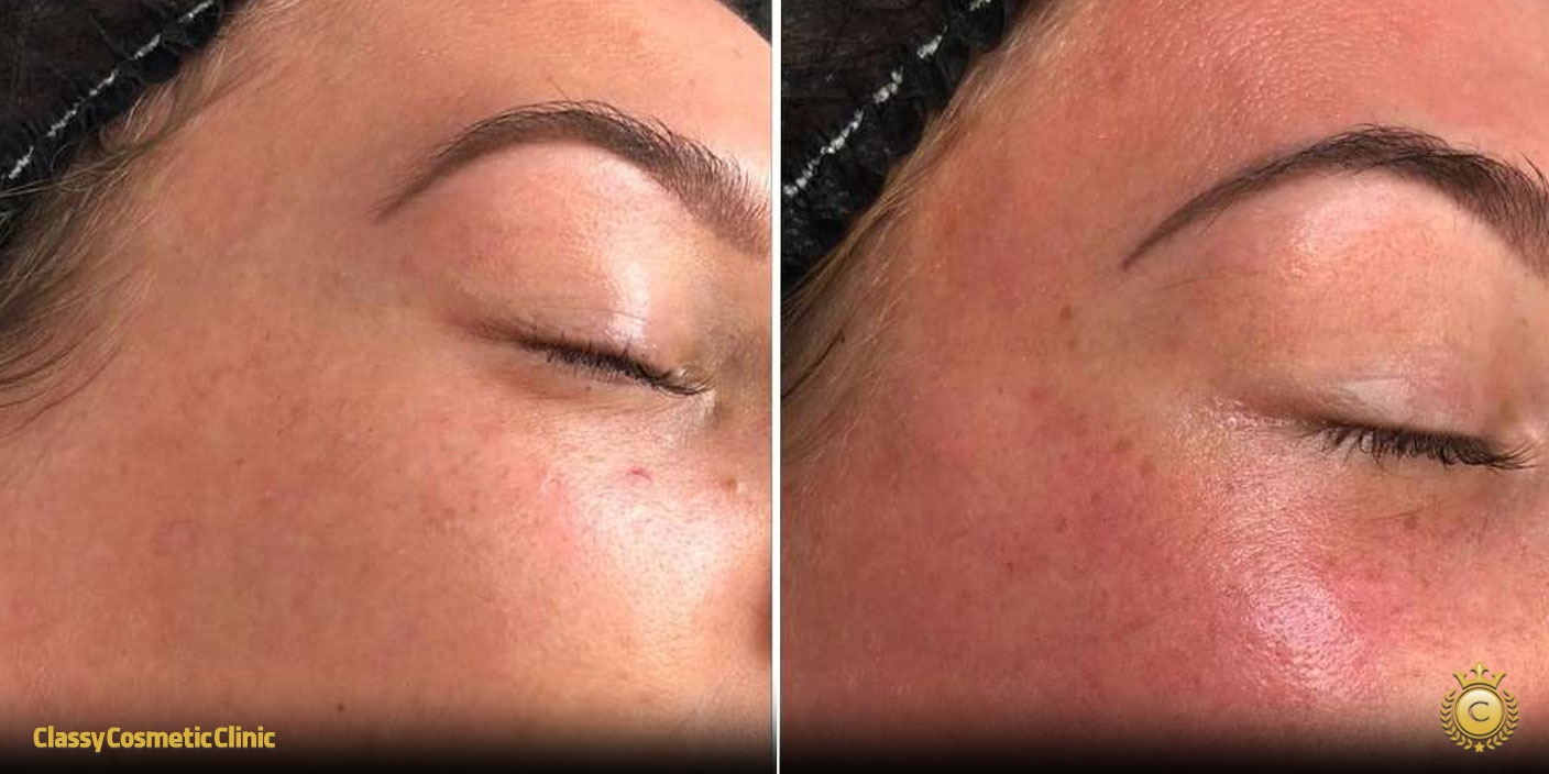 chemical peel before and after