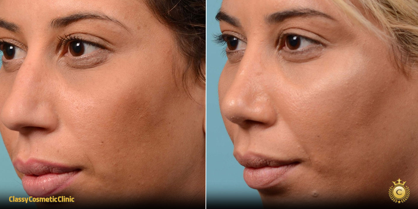 crinkle nose treatment before and after