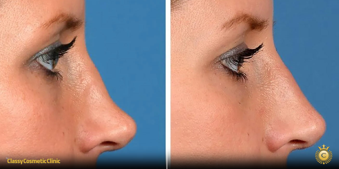 crinkle nose treatment before and after