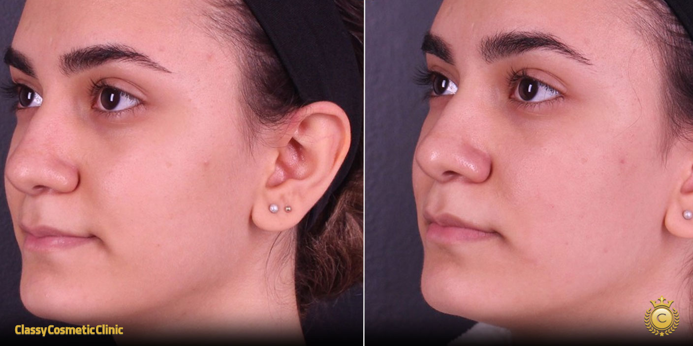 lifting face treatment before and after