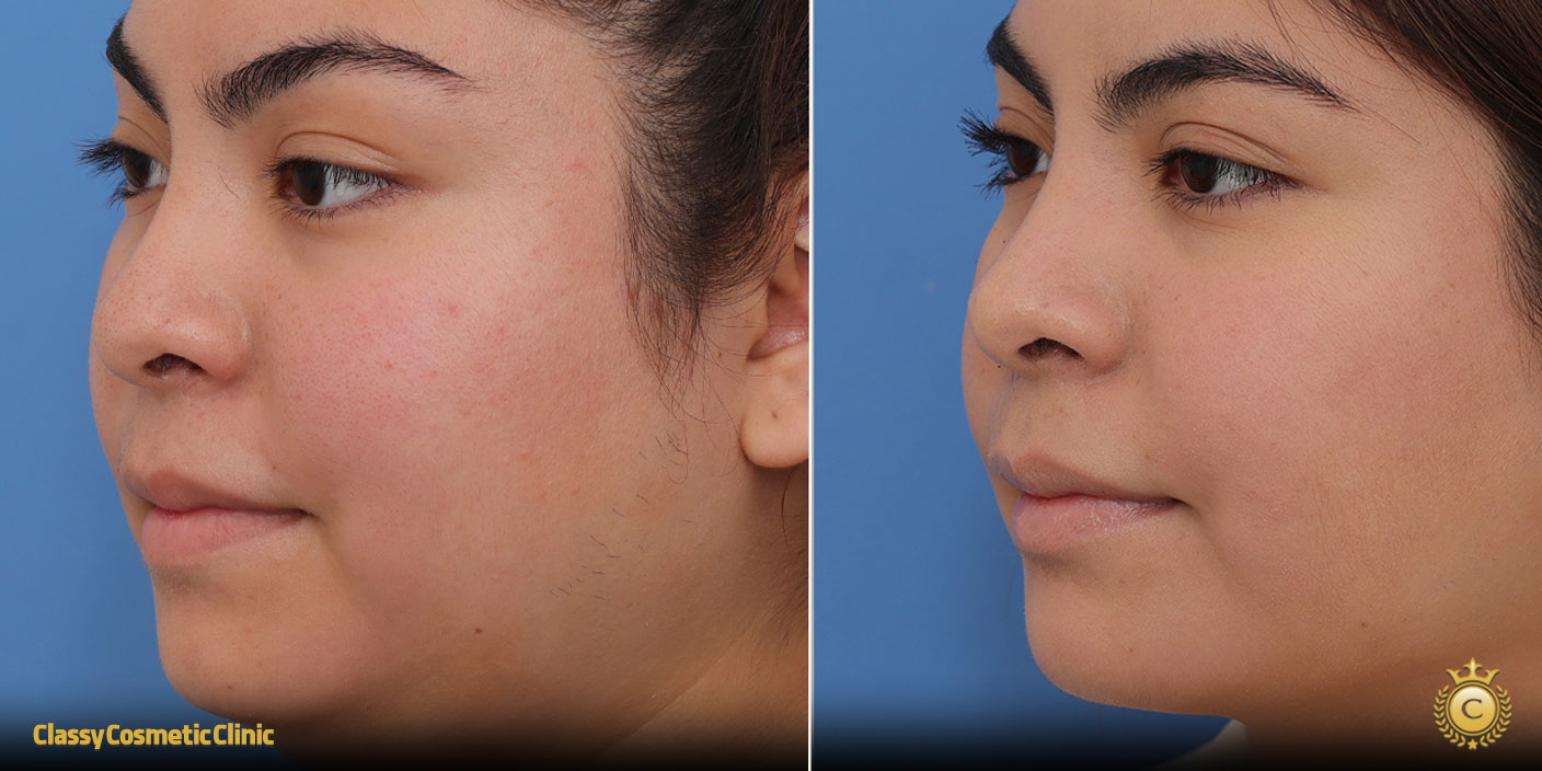 lifting-face-treatment-before-and-after