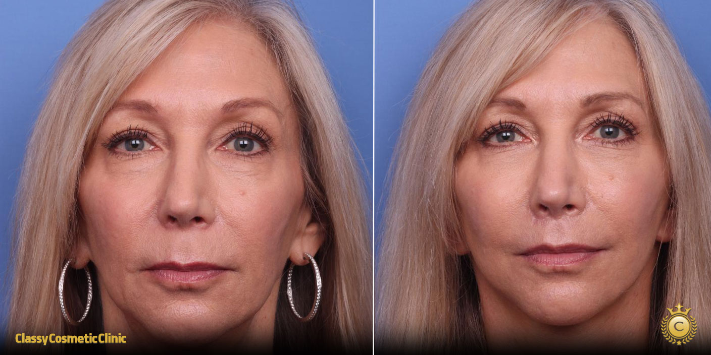 lifting-face-treatment-before-and-after