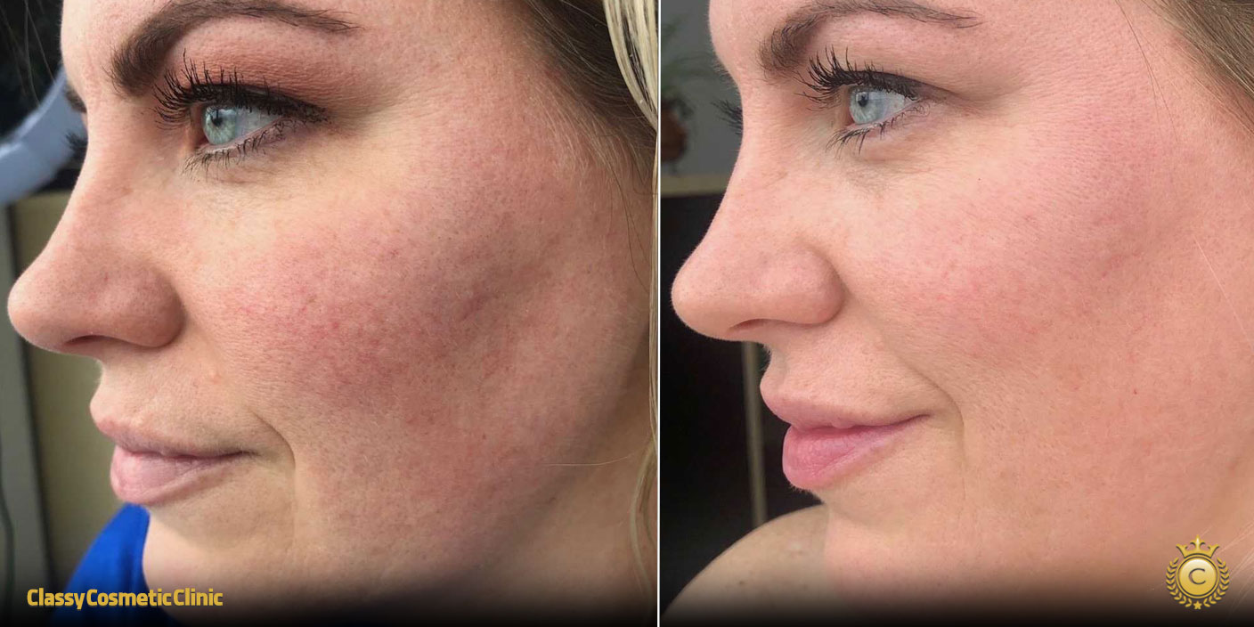 lifting-face-treatment-before-and-after