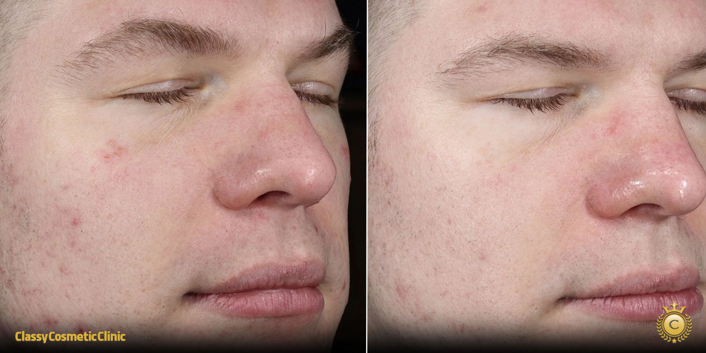 lifting-face-treatment-before-and-after