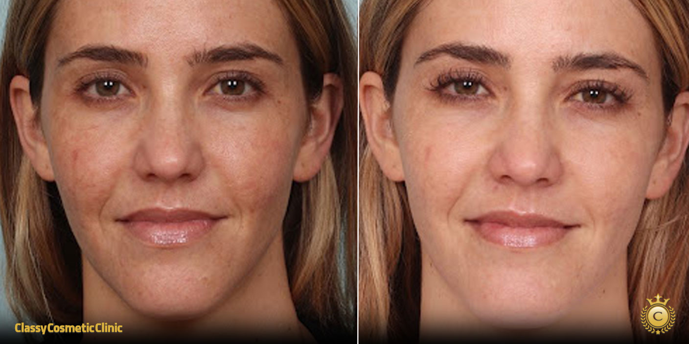 lifting-face-treatment-before-and-after