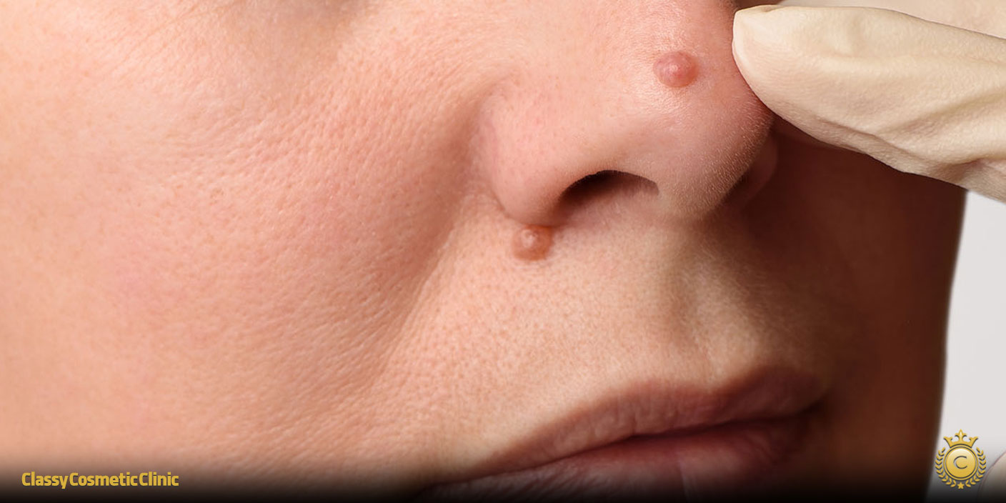 How to Get Rid of Moles on Nose: Effective Home and Clinical Solutions