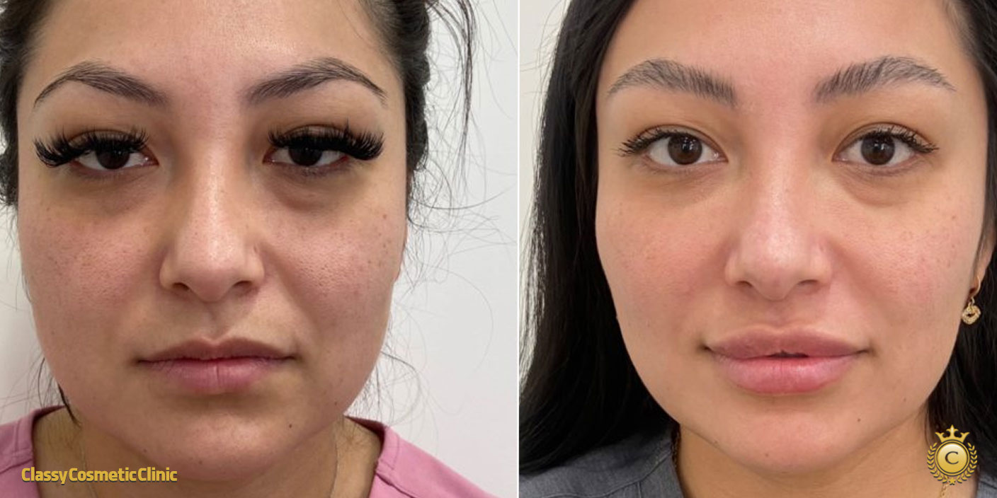 PRP for Facial Rejuvenation before and after