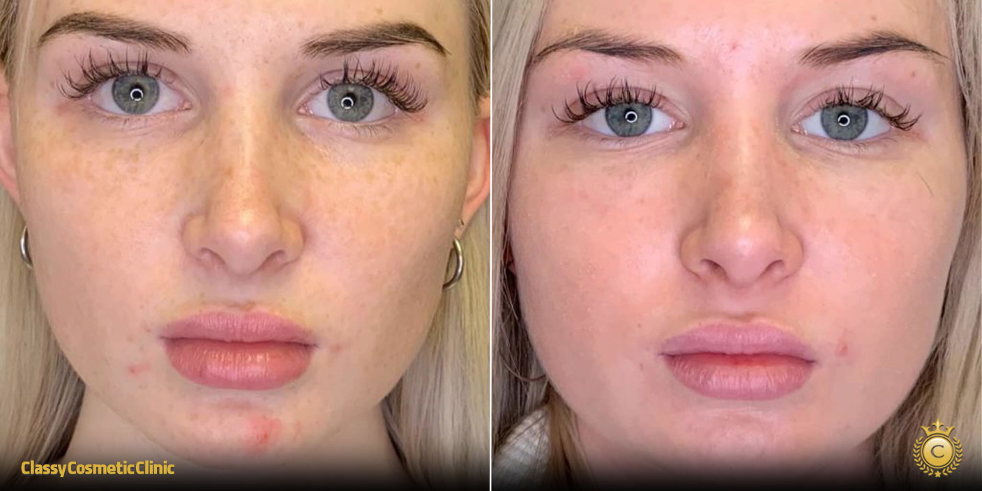 PRP for Facial Rejuvenation before and after