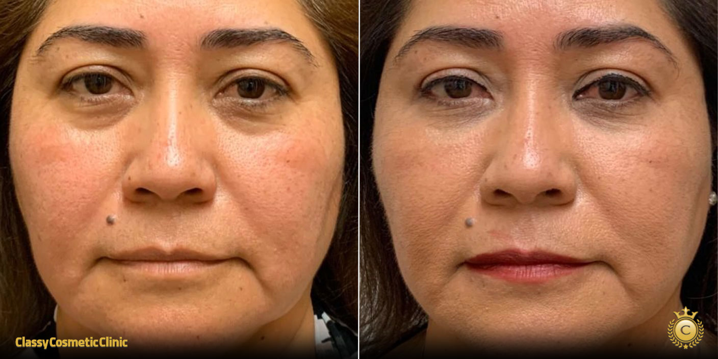 PRP for Facial Rejuvenation before and after