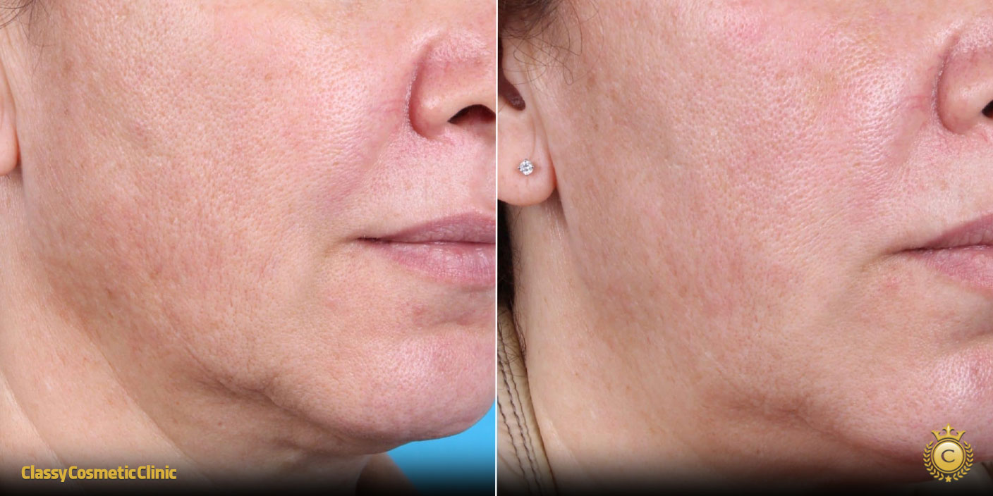 PRP for Facial Rejuvenation before and after