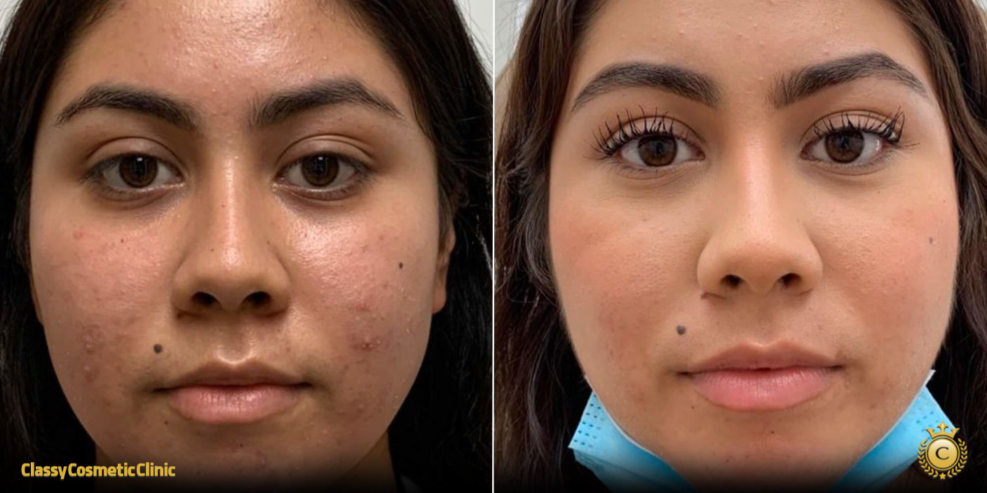 PRP for Facial Rejuvenation before and after