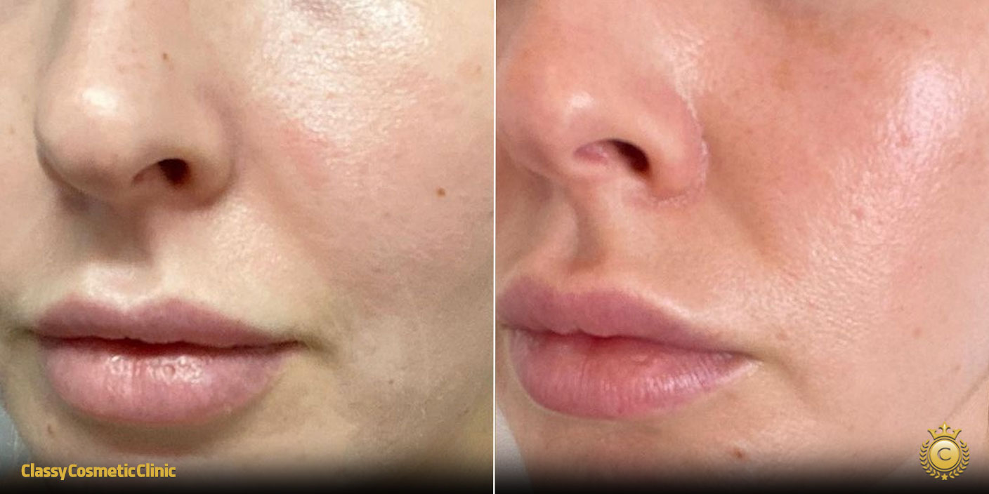 PRP for Facial Rejuvenation before and after